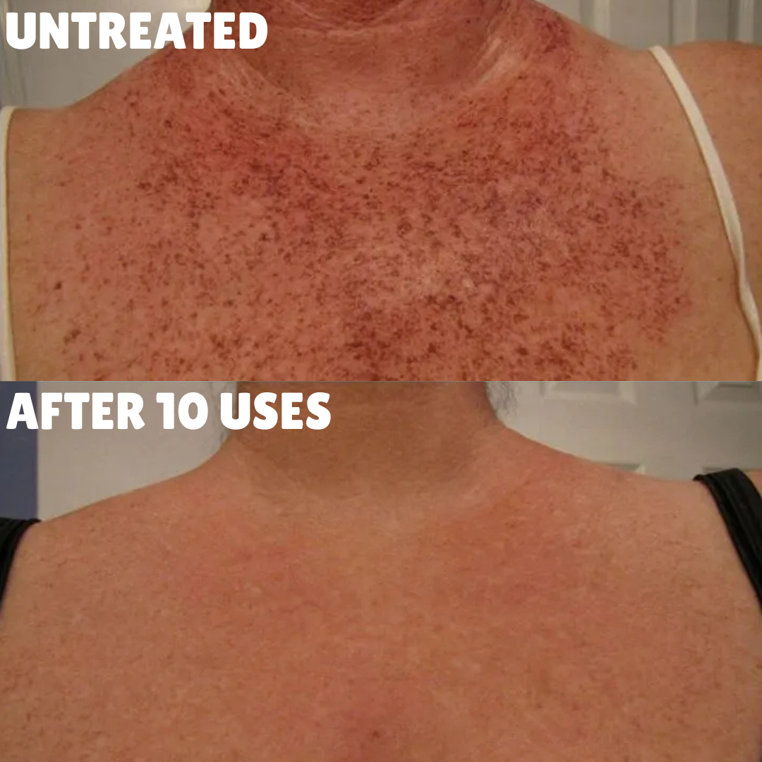 Ultra Strength Hyperpigmentation Brightening Cream