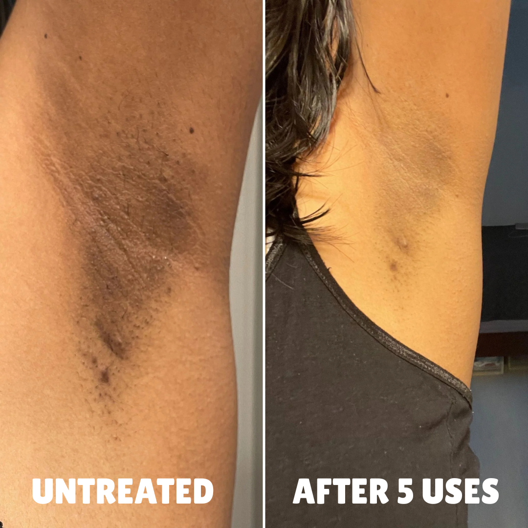 Ultra Strength Hyperpigmentation Brightening Cream