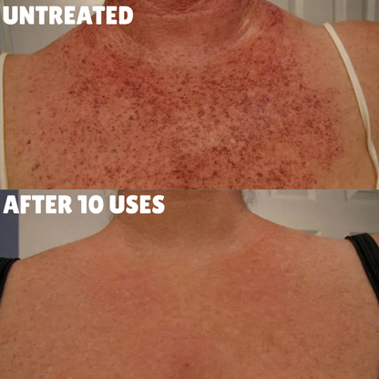 Ultra Strength Hyperpigmentation Brightening Cream