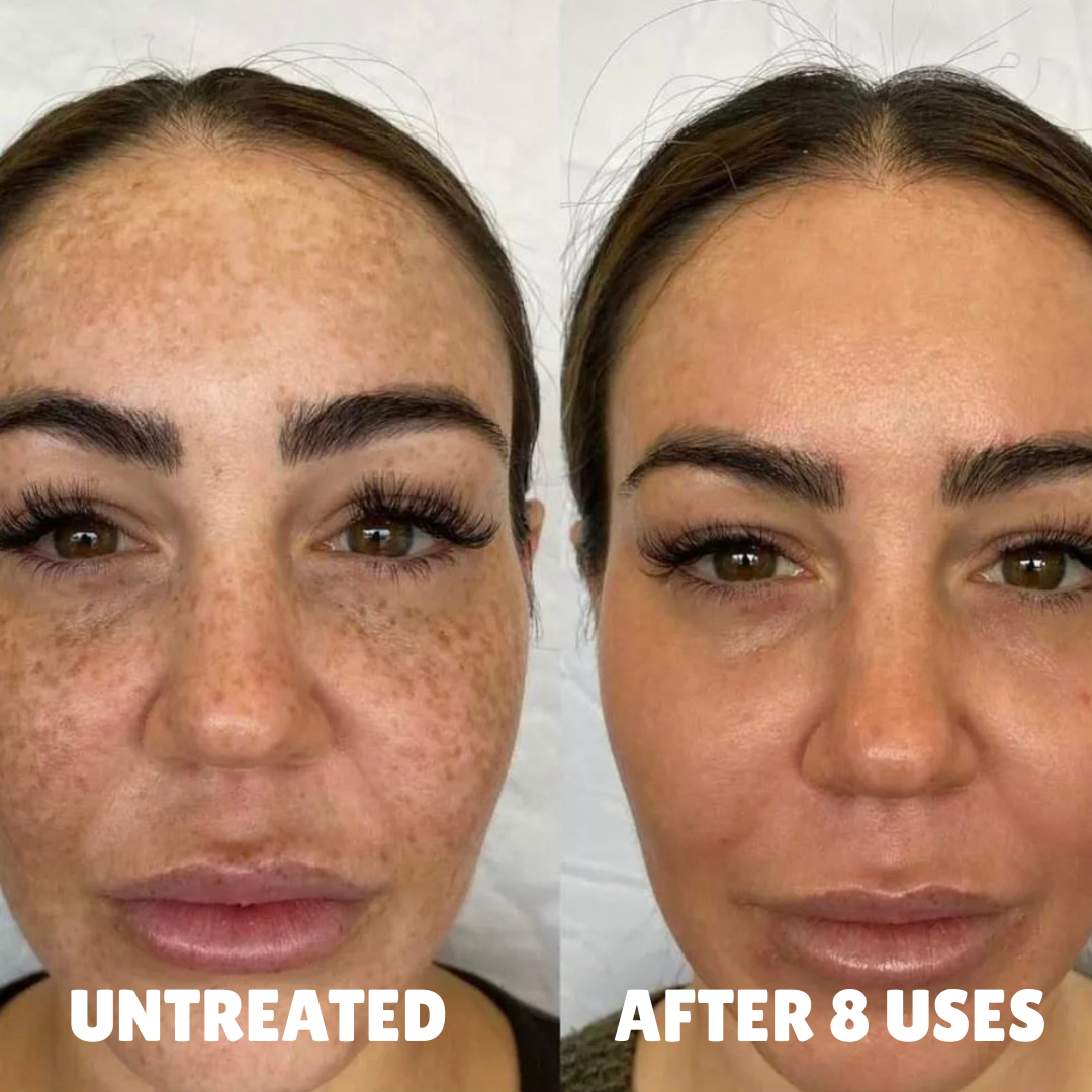 Ultra Strength Hyperpigmentation Brightening Cream